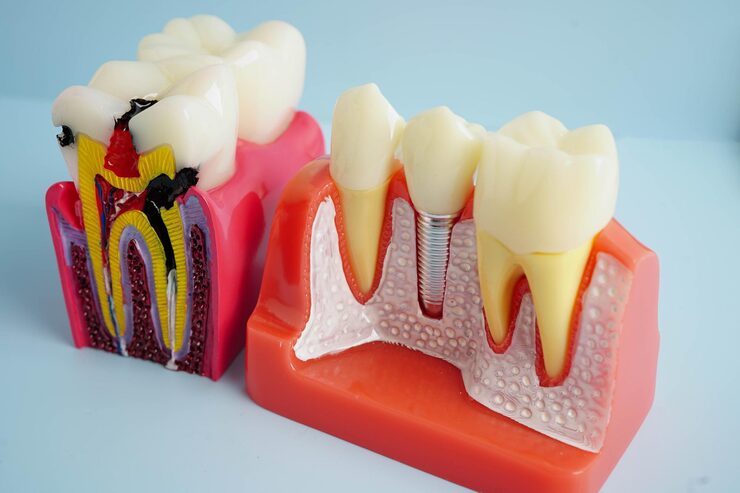 root canal and dental crown model